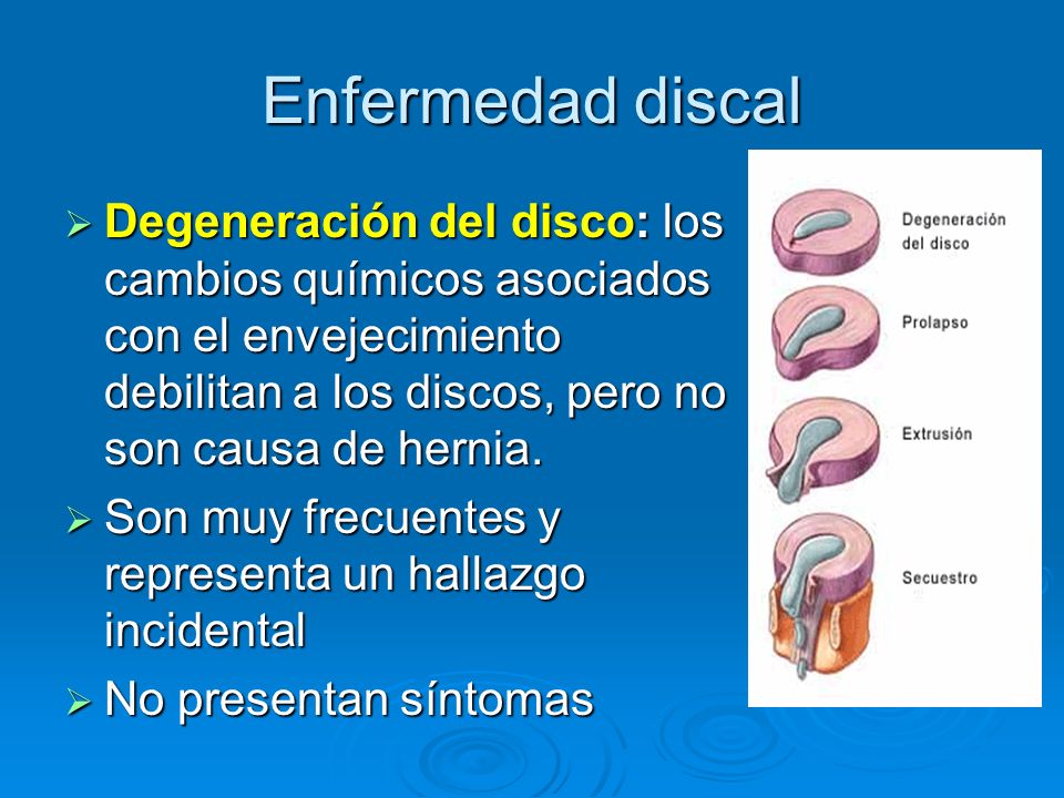Enfermedad discal Degeneración del disco: los cambios químicos asociados con el envejecimiento debilitan a los discos, pero no son causa de hernia.