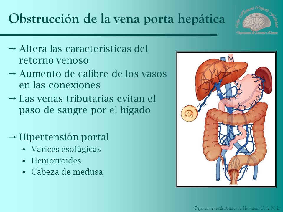 Obstrucción de la vena porta hepática