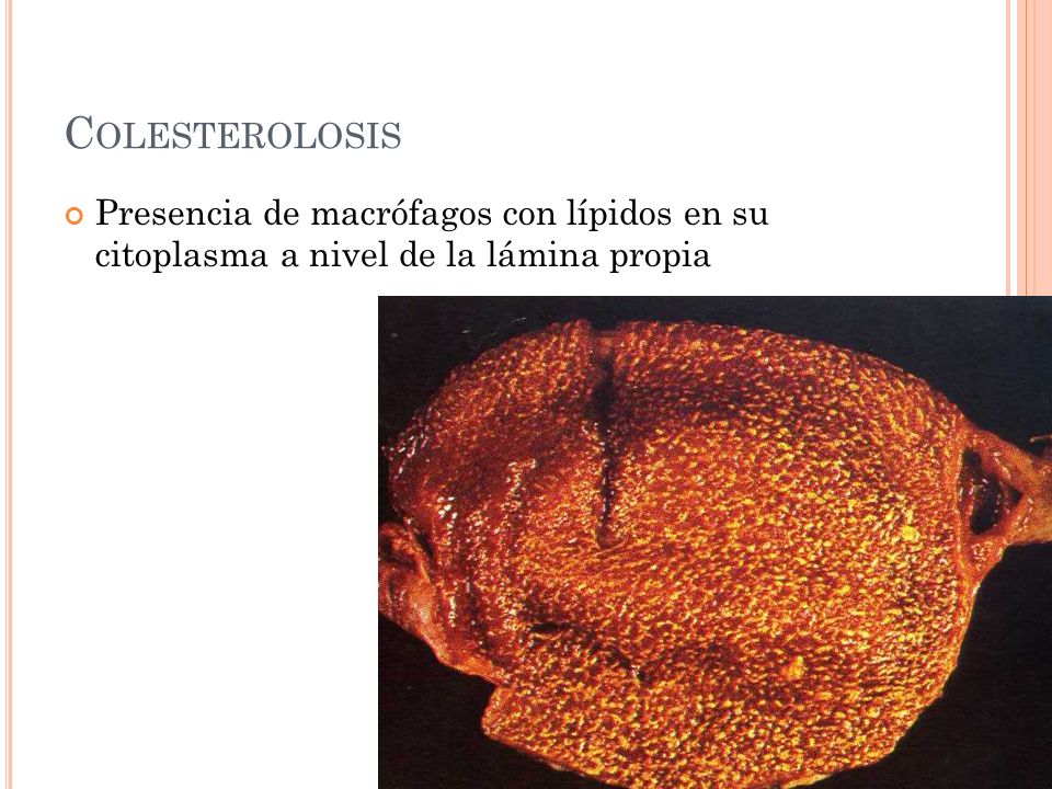 Colesterolosis Presencia de macrófagos con lípidos en su citoplasma a nivel de la lámina propia