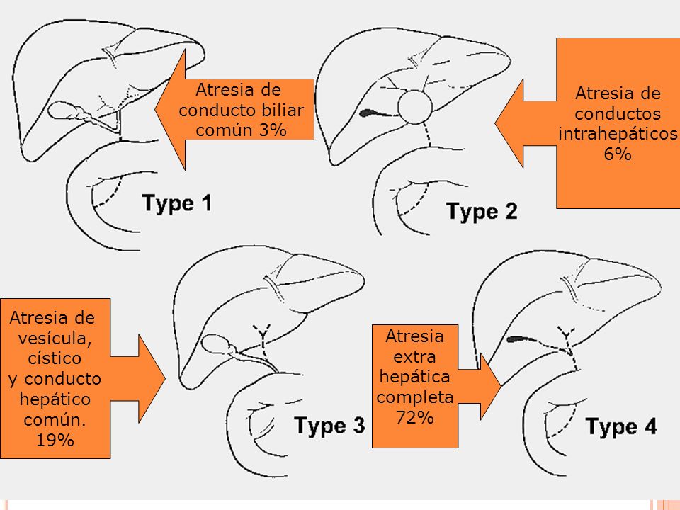 Atresia de conductos. intrahepáticos. 6% Atresia de. conducto biliar. común 3% Atresia de. vesícula,