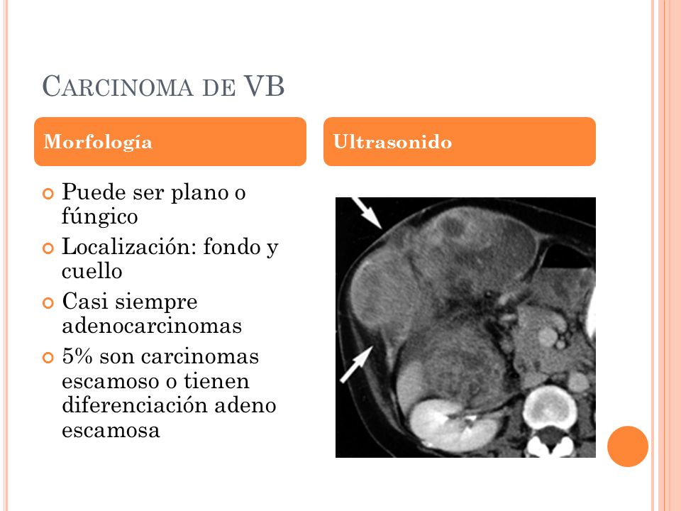 Carcinoma de VB Puede ser plano o fúngico Localización: fondo y cuello