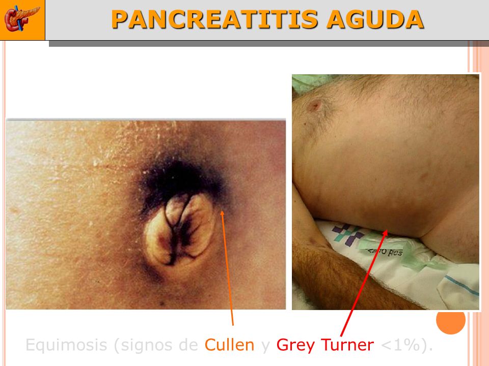 PANCREATITIS AGUDA Equimosis (signos de Cullen y Grey Turner <1%).