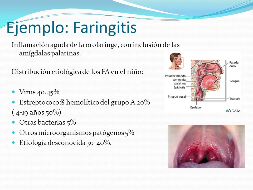 Ejemplo: Faringitis Inflamación aguda de la orofaringe, con inclusión de las amígdalas palatinas. Distribución etiológica de los FA en el niño: