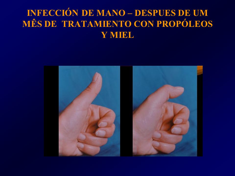 INFECCIÓN DE MANO – DESPUES DE UM MÊS DE TRATAMIENTO CON PROPÓLEOS Y MIEL