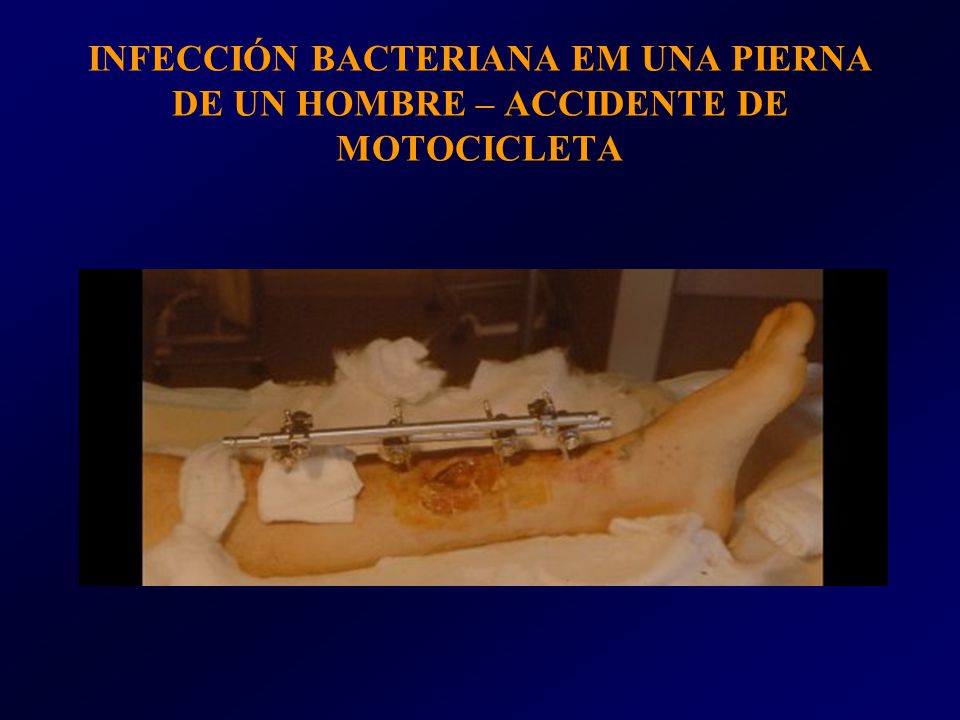 INFECCIÓN BACTERIANA EM UNA PIERNA DE UN HOMBRE – ACCIDENTE DE MOTOCICLETA