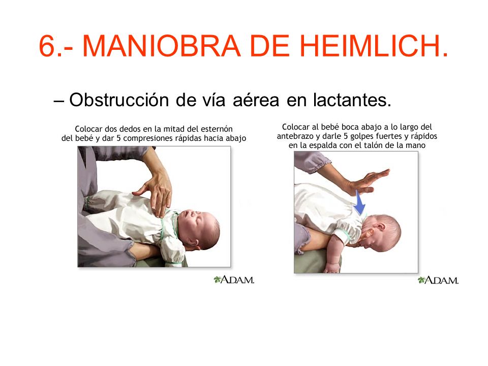 6.- MANIOBRA DE HEIMLICH. Obstrucción de vía aérea en lactantes.