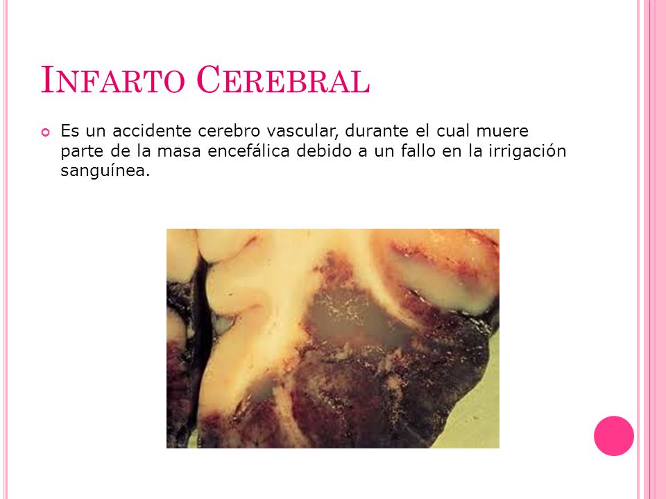 Infarto Cerebral Es un accidente cerebro vascular, durante el cual muere parte de la masa encefálica debido a un fallo en la irrigación sanguínea.
