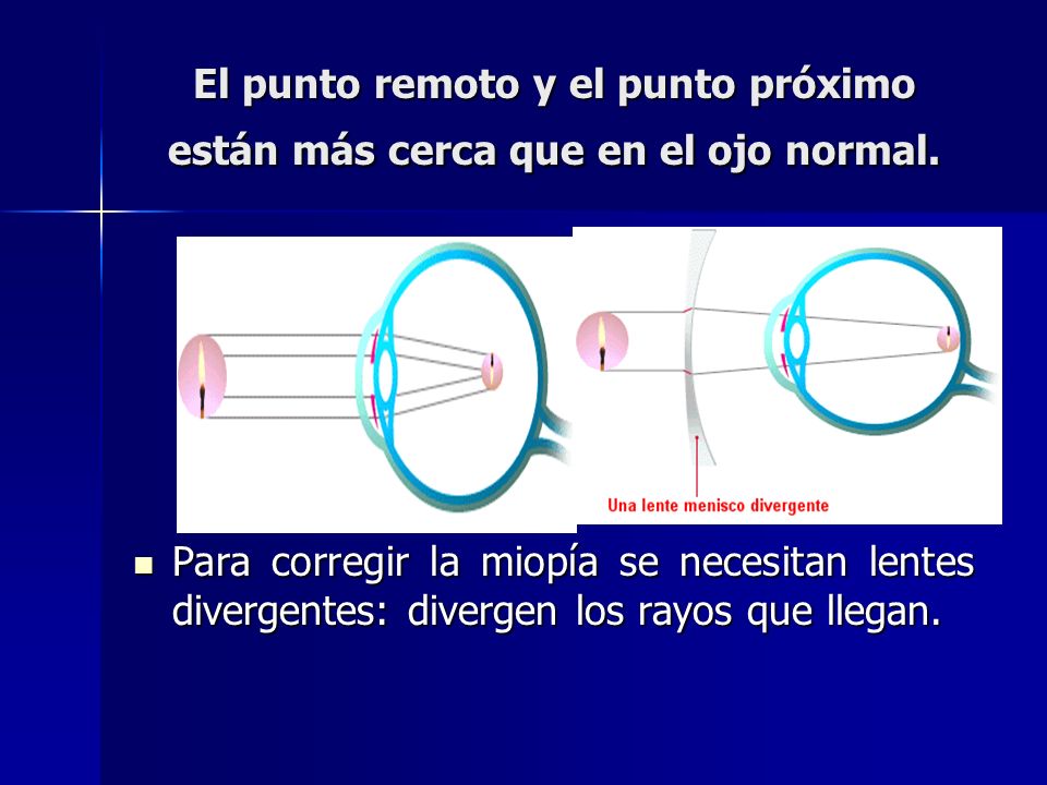 El punto remoto y el punto próximo están más cerca que en el ojo normal.