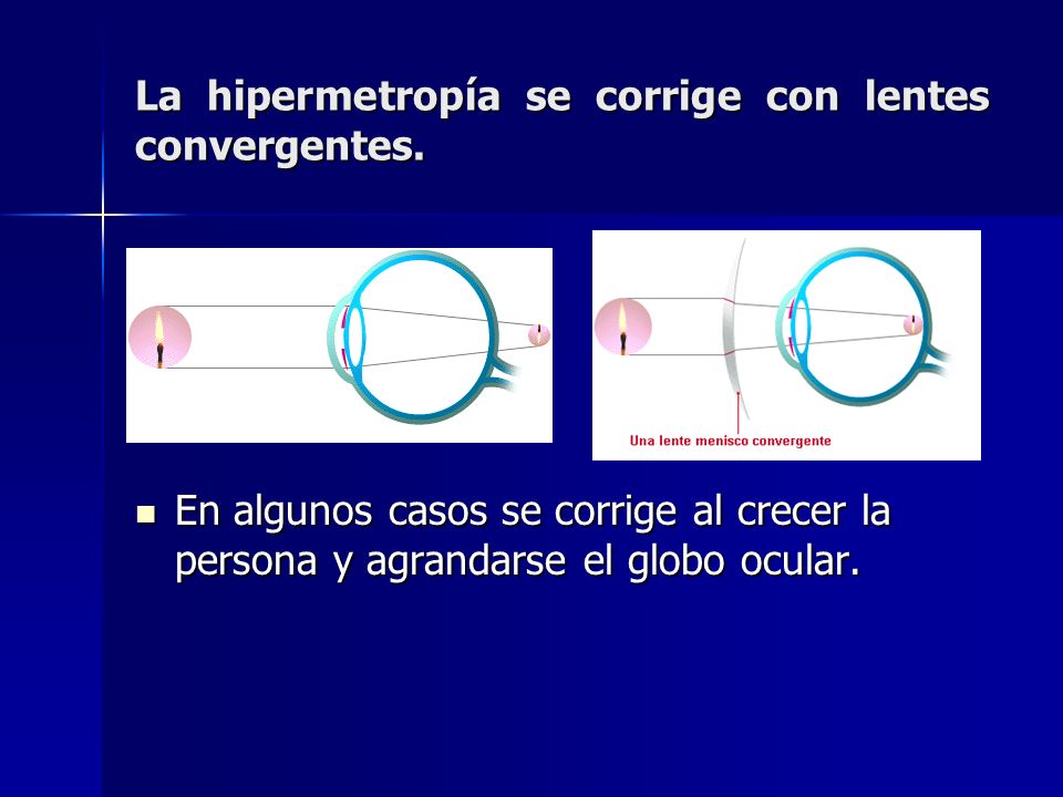 La hipermetropía se corrige con lentes convergentes.