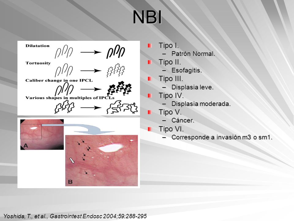 NBI Tipo I. Tipo II. Tipo III. Tipo IV. Tipo V. Tipo VI.