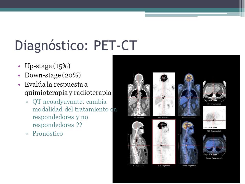 Diagnóstico: PET-CT Up-stage (15%) Down-stage (20%)