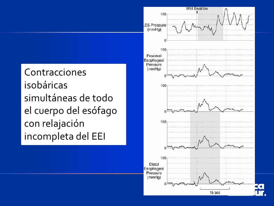 Contracciones isobáricas simultáneas de todo el cuerpo del esófago con relajación incompleta del EEI