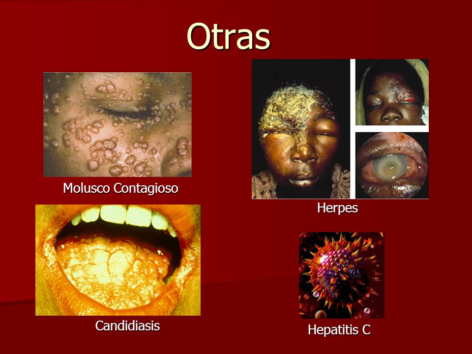 Otras Molusco Contagioso Herpes Candidiasis Hepatitis C