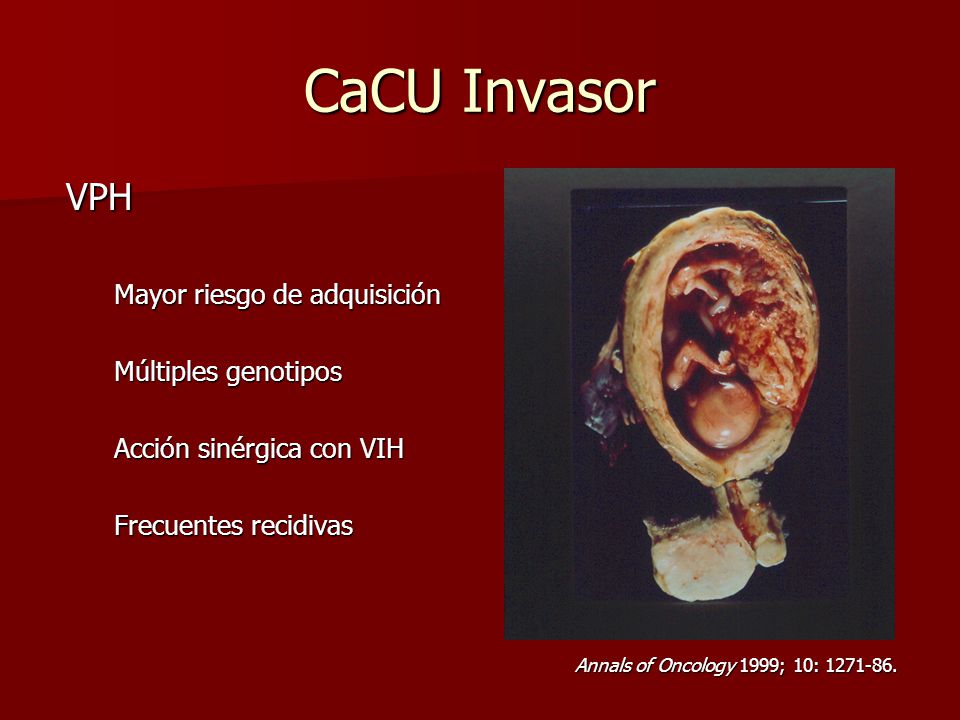 CaCU Invasor VPH Mayor riesgo de adquisición Múltiples genotipos