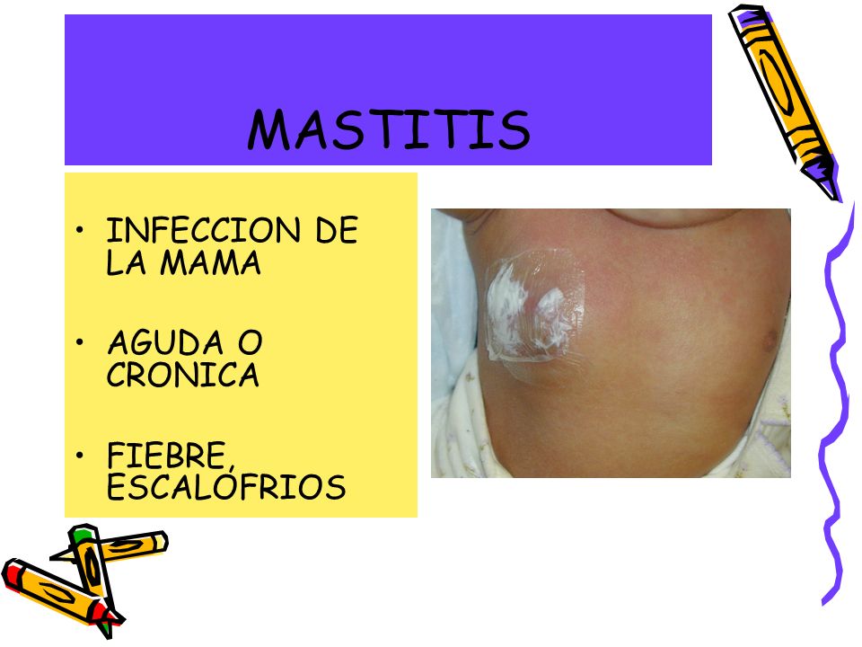 MASTITIS INFECCION DE LA MAMA AGUDA O CRONICA FIEBRE, ESCALOFRIOS
