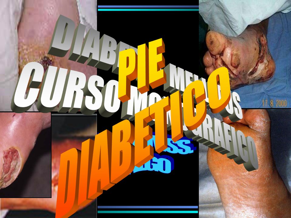 PIE DIABETICO DIABETES MELLITUS CURSO MONOGRAFICO HGZ N°1, IMSS. HIDALGO