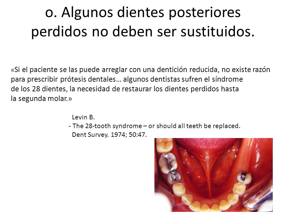 o. Algunos dientes posteriores perdidos no deben ser sustituidos.