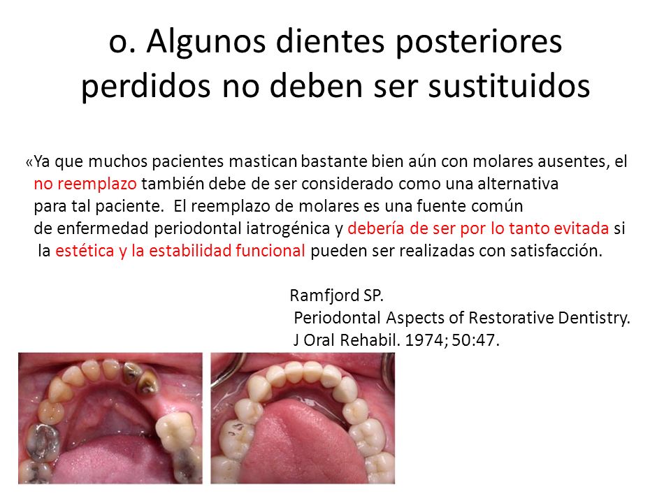 o. Algunos dientes posteriores perdidos no deben ser sustituidos