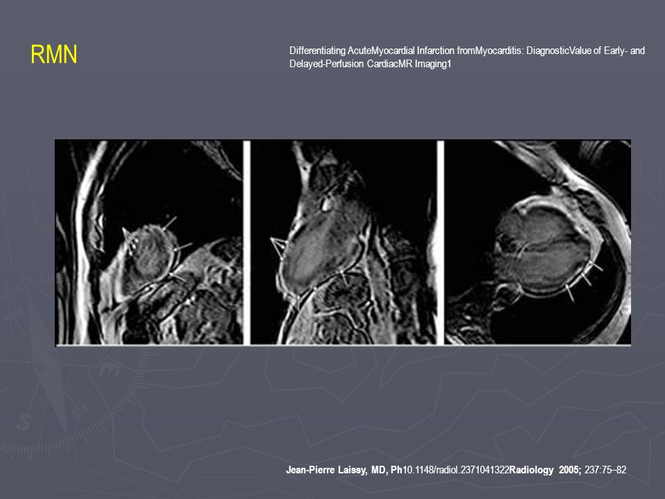 RMN Differentiating AcuteMyocardial Infarction fromMyocarditis: DiagnosticValue of Early- and. Delayed-Perfusion CardiacMR Imaging1.