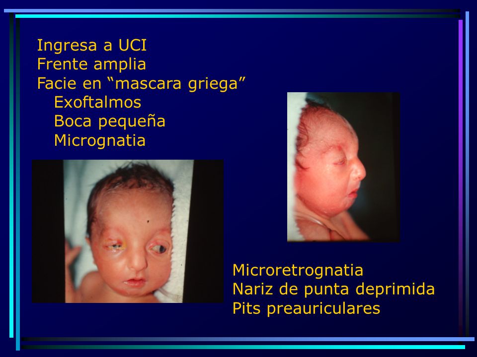 Ingresa a UCI Frente amplia. Facie en mascara griega Exoftalmos. Boca pequeña. Micrognatia. Microretrognatia.
