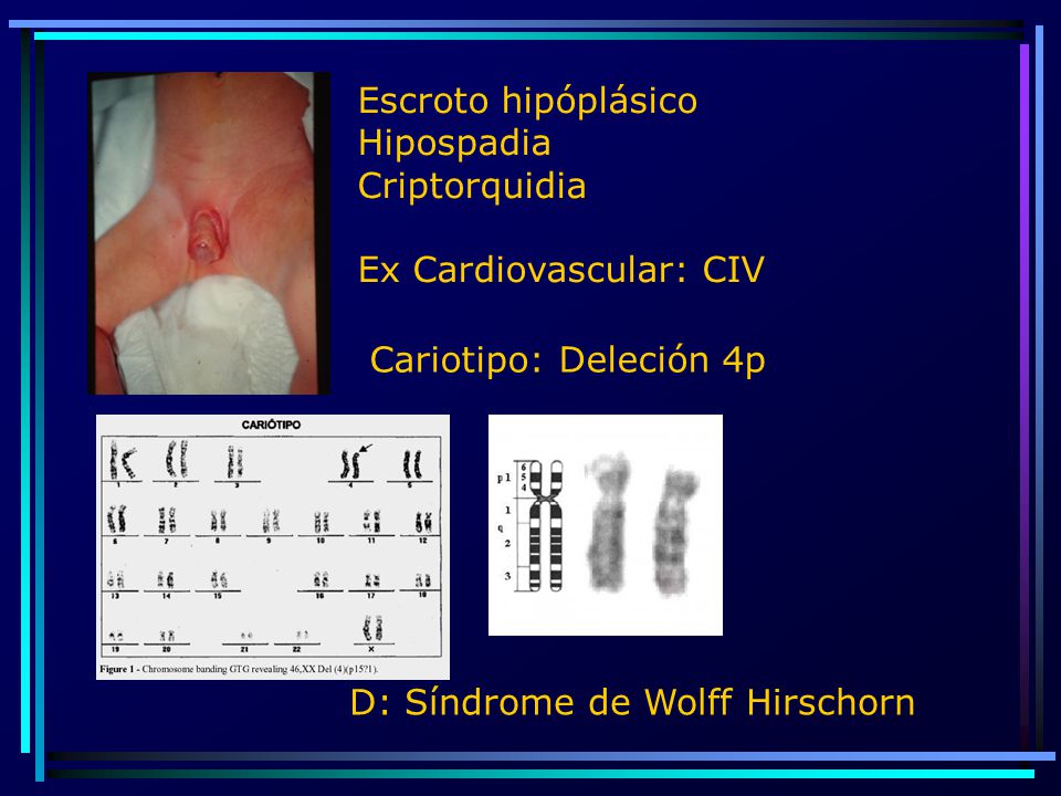 Escroto hipóplásico Hipospadia. Criptorquidia. Ex Cardiovascular: CIV.