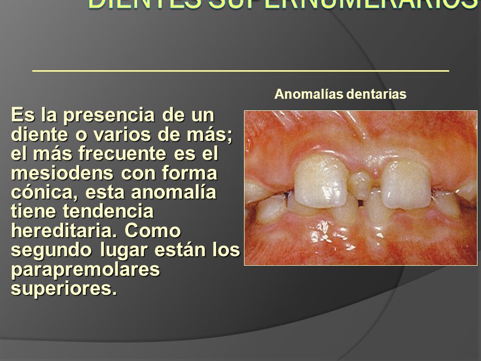 Dientes Supernumerarios