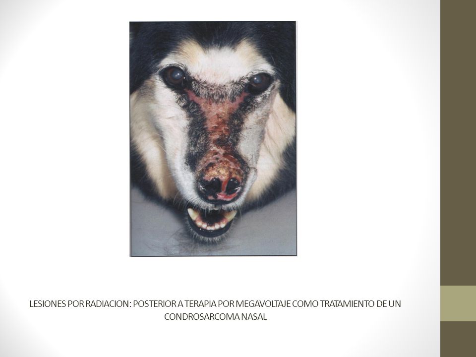 LESIONES POR RADIACION: POSTERIOR A TERAPIA POR MEGAVOLTAJE COMO TRATAMIENTO DE UN CONDROSARCOMA NASAL
