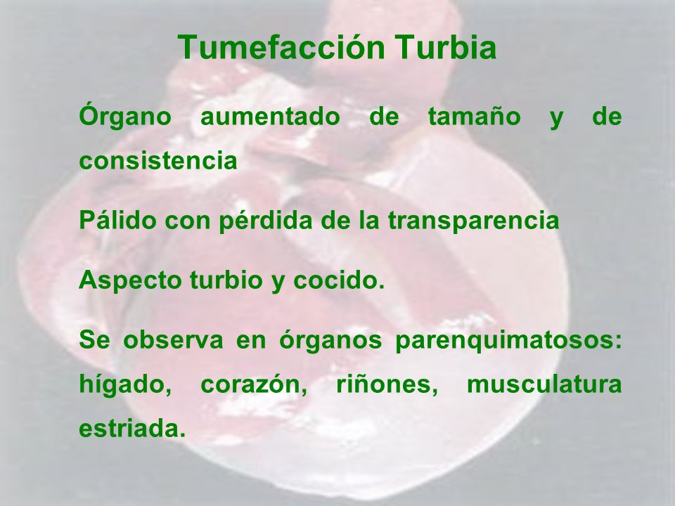 Tumefacción Turbia Órgano aumentado de tamaño y de consistencia