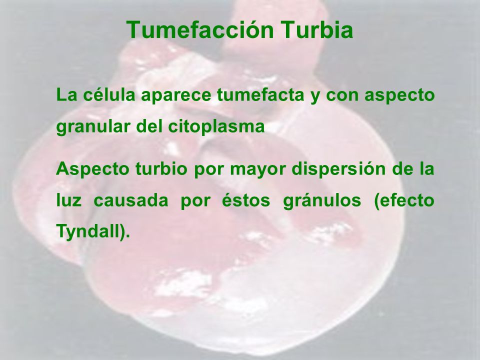 Tumefacción Turbia La célula aparece tumefacta y con aspecto granular del citoplasma.