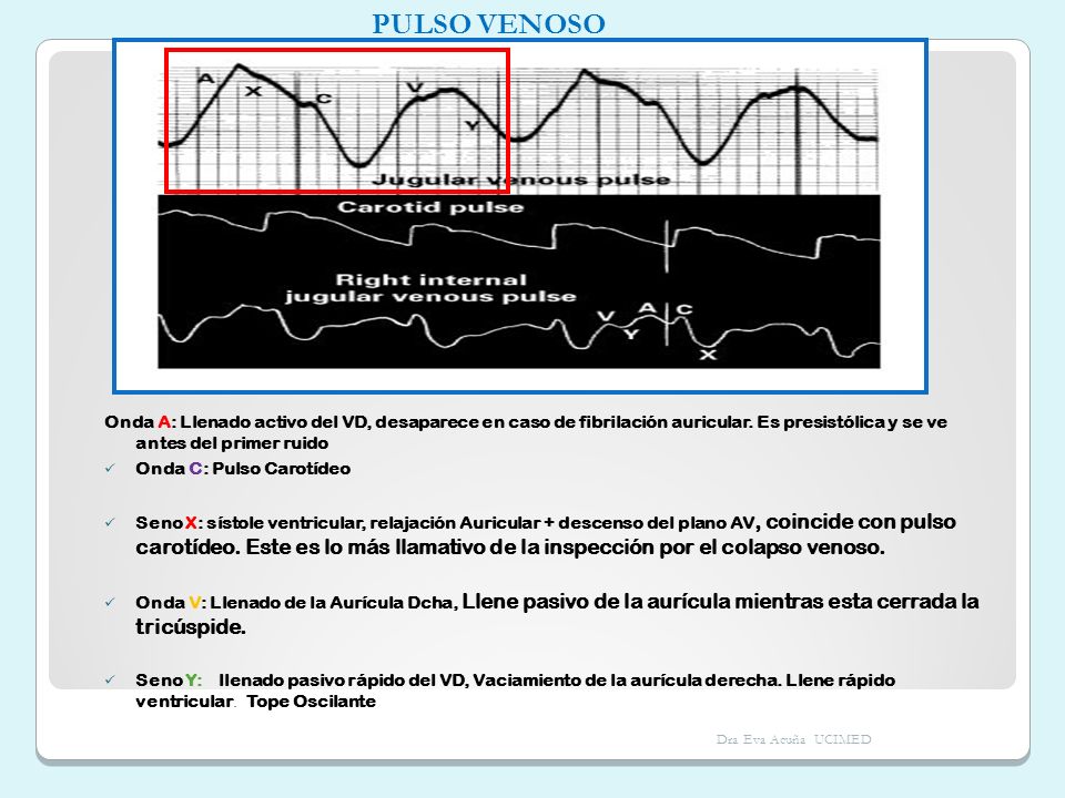 PULSO VENOSO Onda A: Llenado activo del VD, desaparece en caso de fibrilación auricular. Es presistólica y se ve antes del primer ruido.