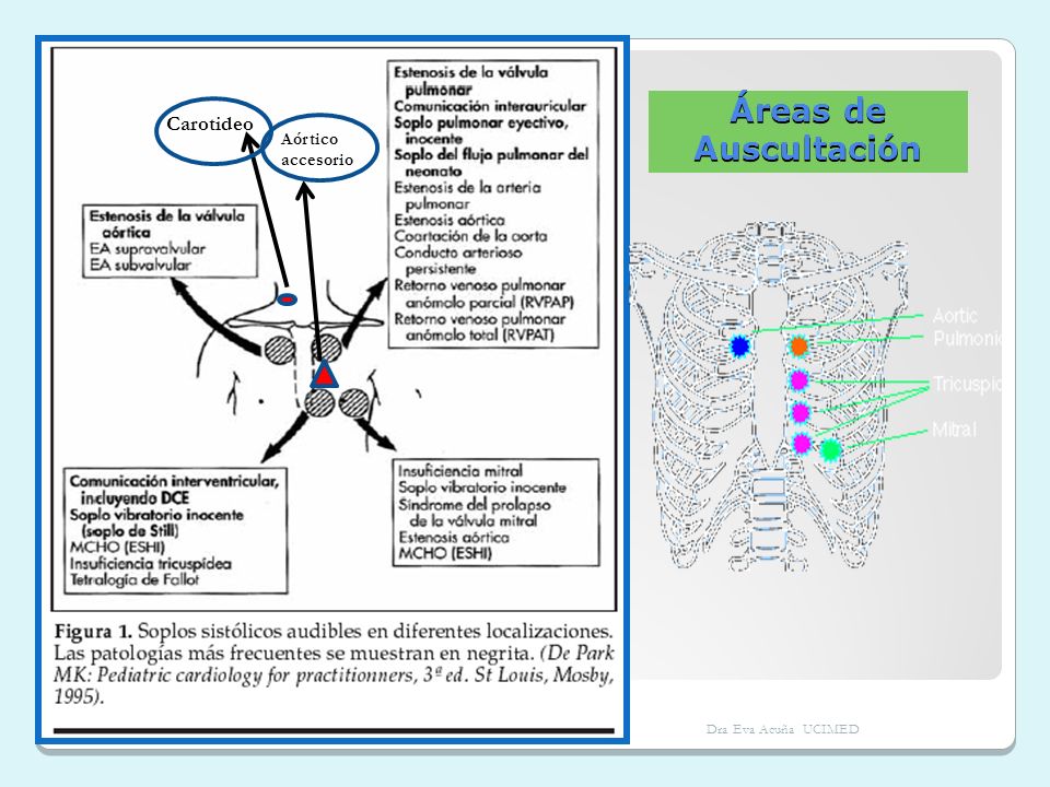 Áreas de Auscultación Carotideo Aórtico accesorio Dra Eva Acuña UCIMED