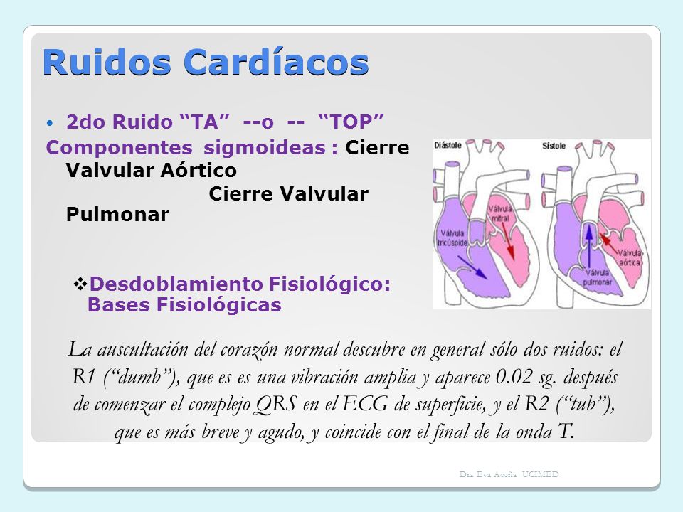 Ruidos Cardíacos 2do Ruido TA --o -- TOP Componentes sigmoideas : Cierre Valvular Aórtico.