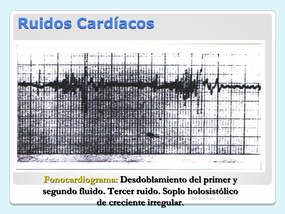 Ruidos Cardíacos Fonocardiograma: Desdoblamiento del primer y segundo fluido. Tercer ruido. Soplo holosistólico de creciente irregular.