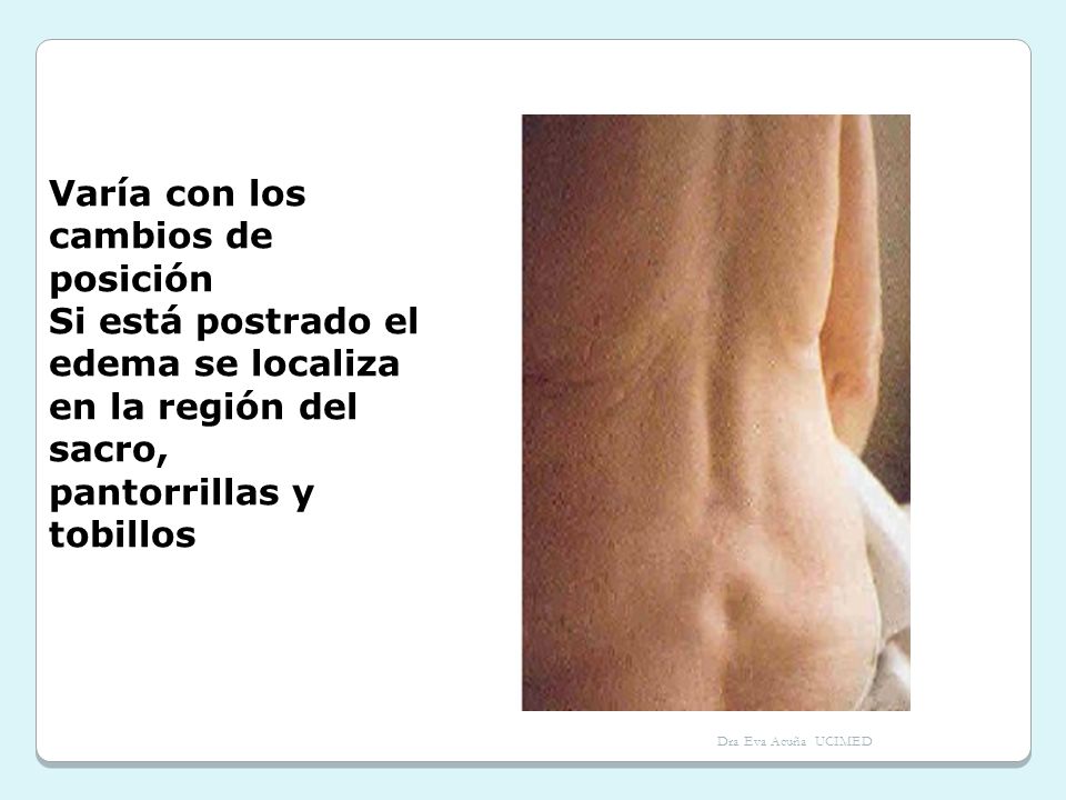 Si está postrado el edema se localiza en la región del sacro,