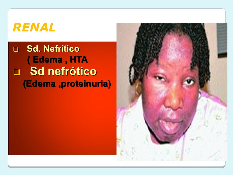 RENAL Sd. Nefrítico ( Edema , HTA Sd nefrótico (Edema ,proteinuria)