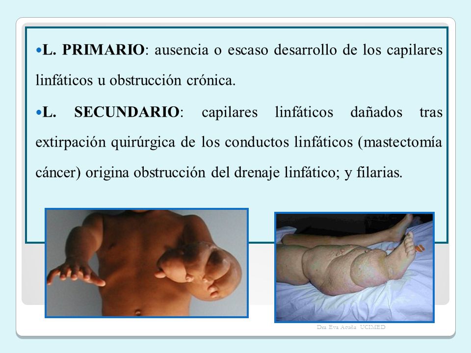 L. PRIMARIO: ausencia o escaso desarrollo de los capilares linfáticos u obstrucción crónica.