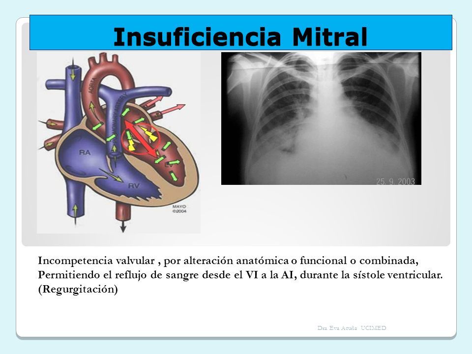 Insuficiencia Mitral Incompetencia valvular , por alteración anatómica o funcional o combinada,