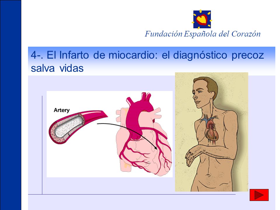 4-. El Infarto de miocardio: el diagnóstico precoz salva vidas