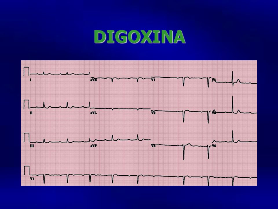 DIGOXINA Electro 33o con PR que se va prolongando, bloqueo AV d e segundo grado QT corto, abombamiento del ST en.