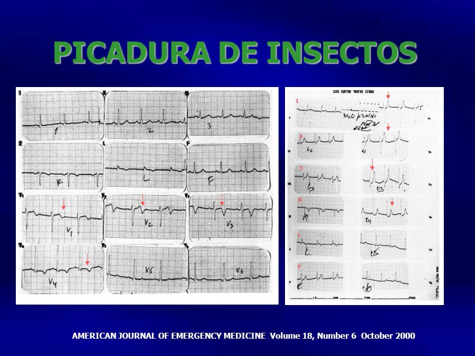 PICADURA DE INSECTOS R. 1inversión de la T de V1 a V4 2. Ondas t hiperagudas. L.