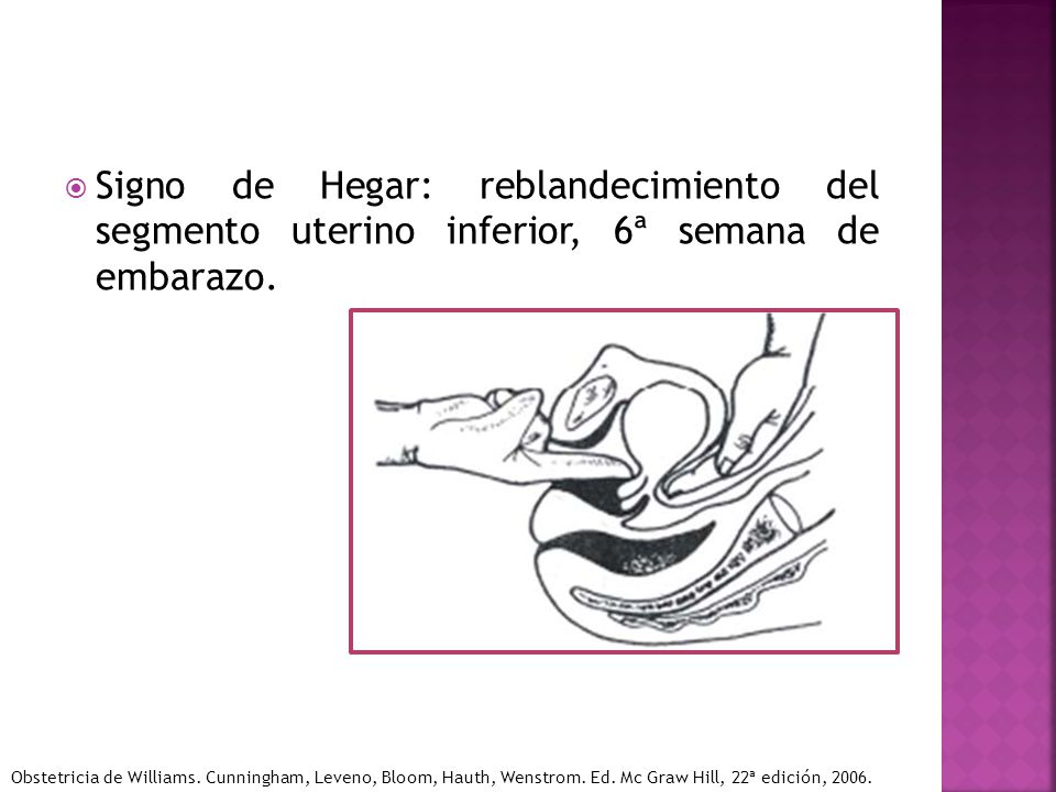 Signo de Hegar: reblandecimiento del segmento uterino inferior, 6ª semana de embarazo.