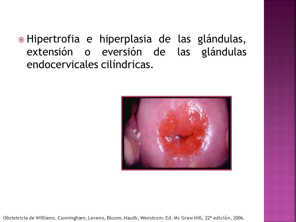 Hipertrofia e hiperplasia de las glándulas, extensión o eversión de las glándulas endocervicales cilíndricas.