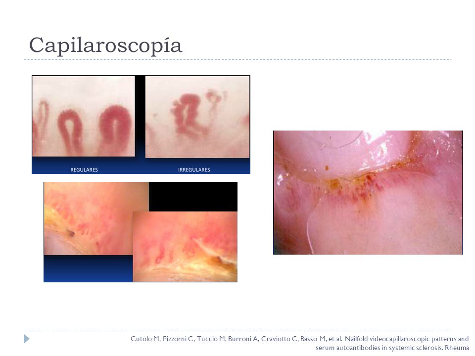 Capilaroscopía Cutolo M, Pizzorni C, Tuccio M, Burroni A, Craviotto C, Basso M, et al. Nailfold videocapillaroscopic patterns and.