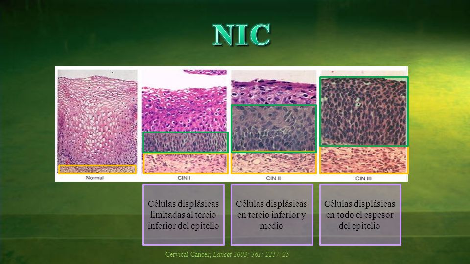 NIC Células displásicas limitadas al tercio inferior del epitelio