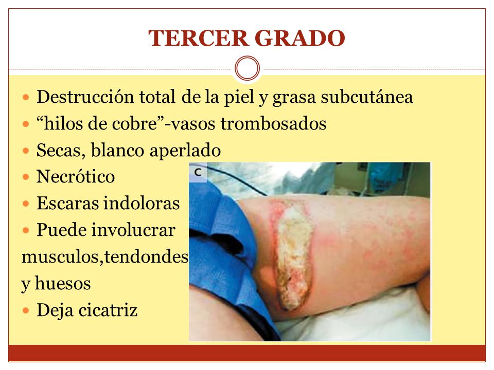 TERCER GRADO Destrucción total de la piel y grasa subcutánea