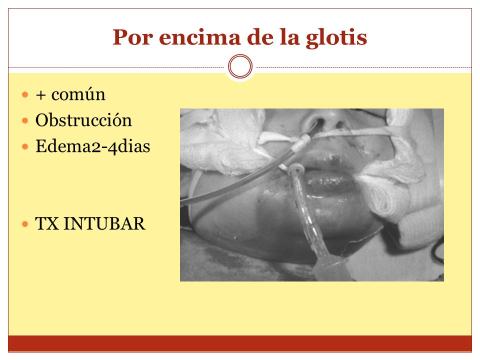 Por encima de la glotis + común Obstrucción Edema2-4dias TX INTUBAR