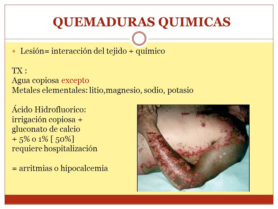 QUEMADURAS QUIMICAS Lesión= interacción del tejido + químico TX :