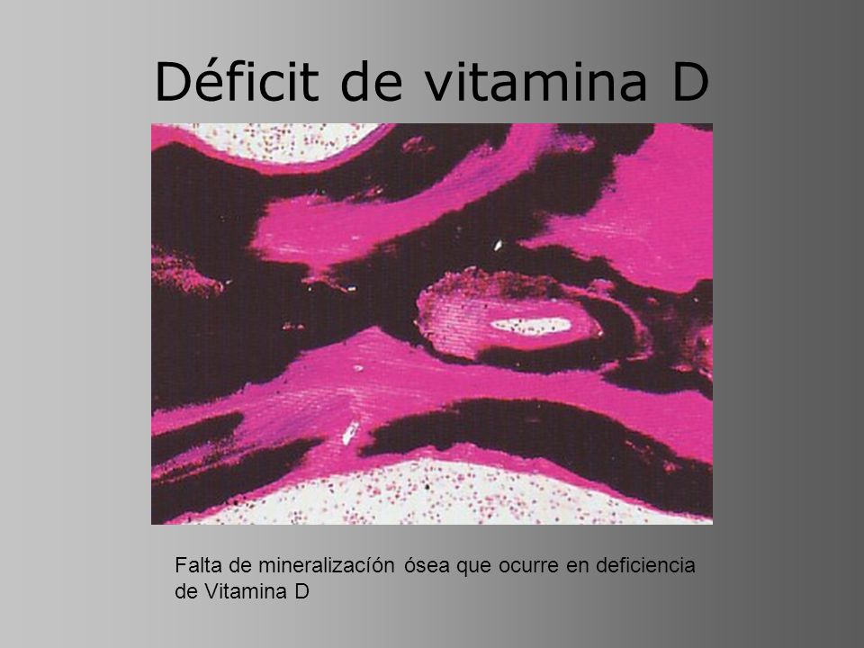 Déficit de vitamina D Falta de mineralizacíón ósea que ocurre en deficiencia de Vitamina D