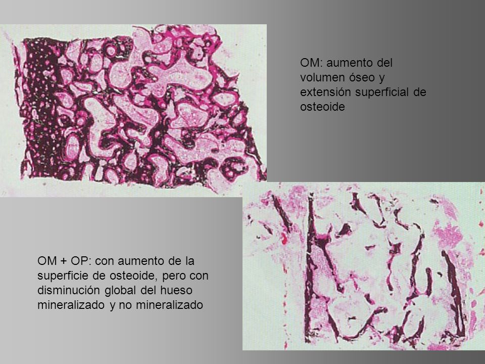 OM: aumento del volumen óseo y extensión superficial de osteoide
