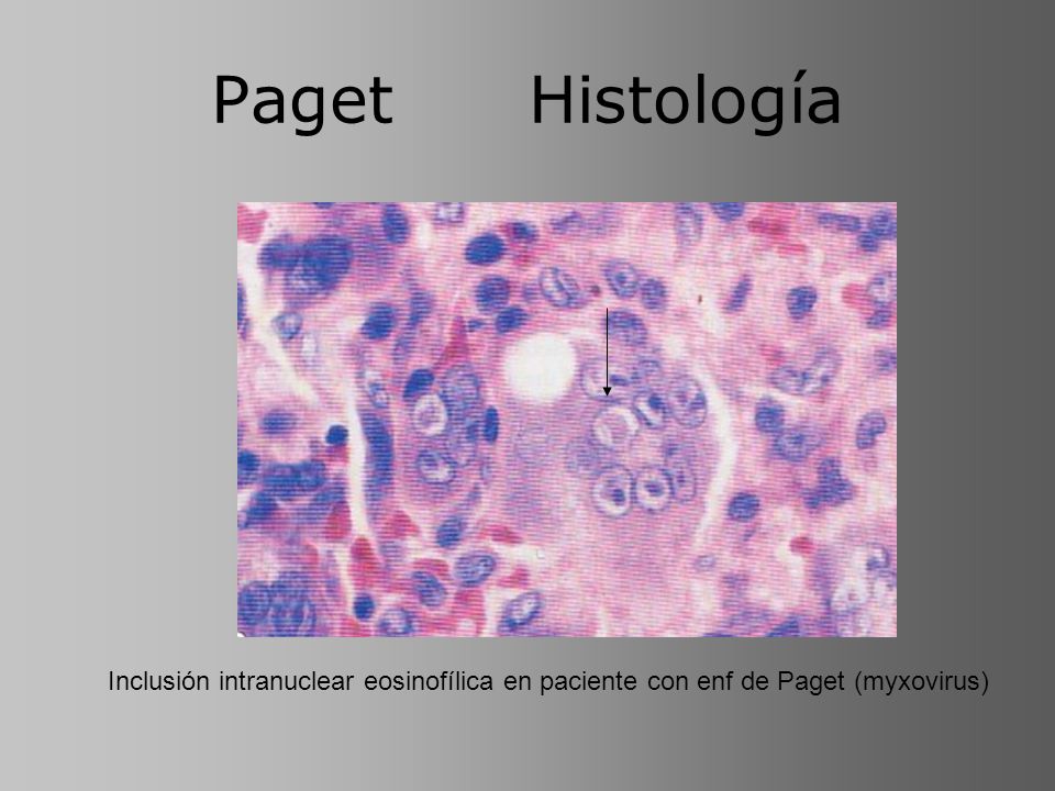 Paget Histología Inclusión intranuclear eosinofílica en paciente con enf de Paget (myxovirus)